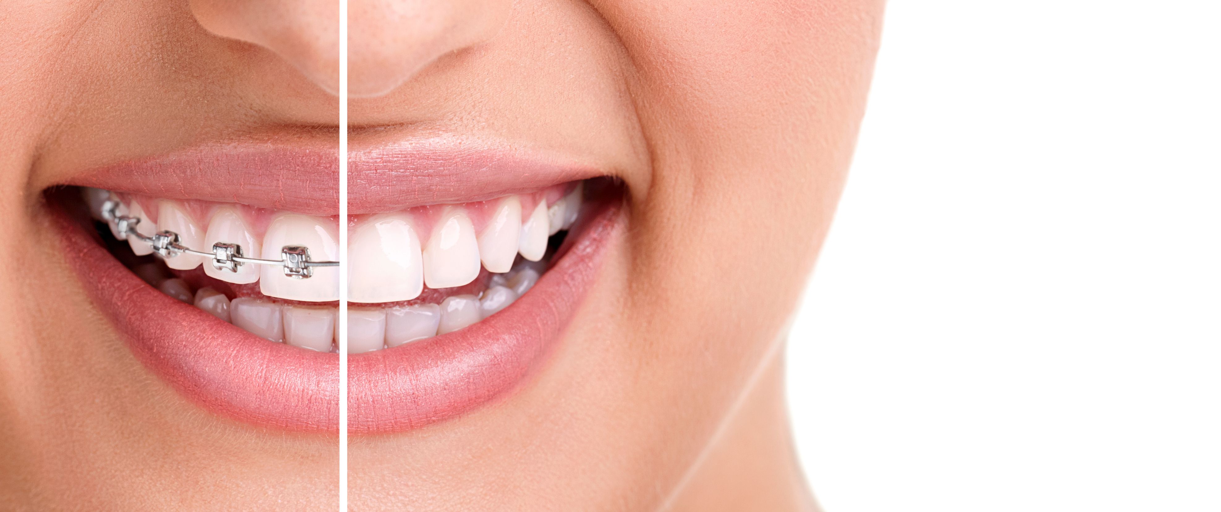 invisalign-dentist-in-cary-nc-top-3-benefits-to-invisalign
