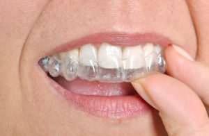 Invisalign Morrisville